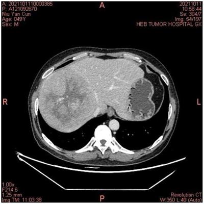 Severe thyrotoxicosis induced by tislelizumab: a case report and literature review